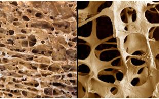 OSTEOPOROSH